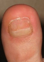 Na nagelreparatie