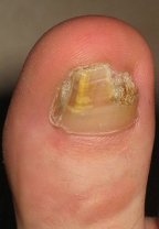 Voor nagelreparatie